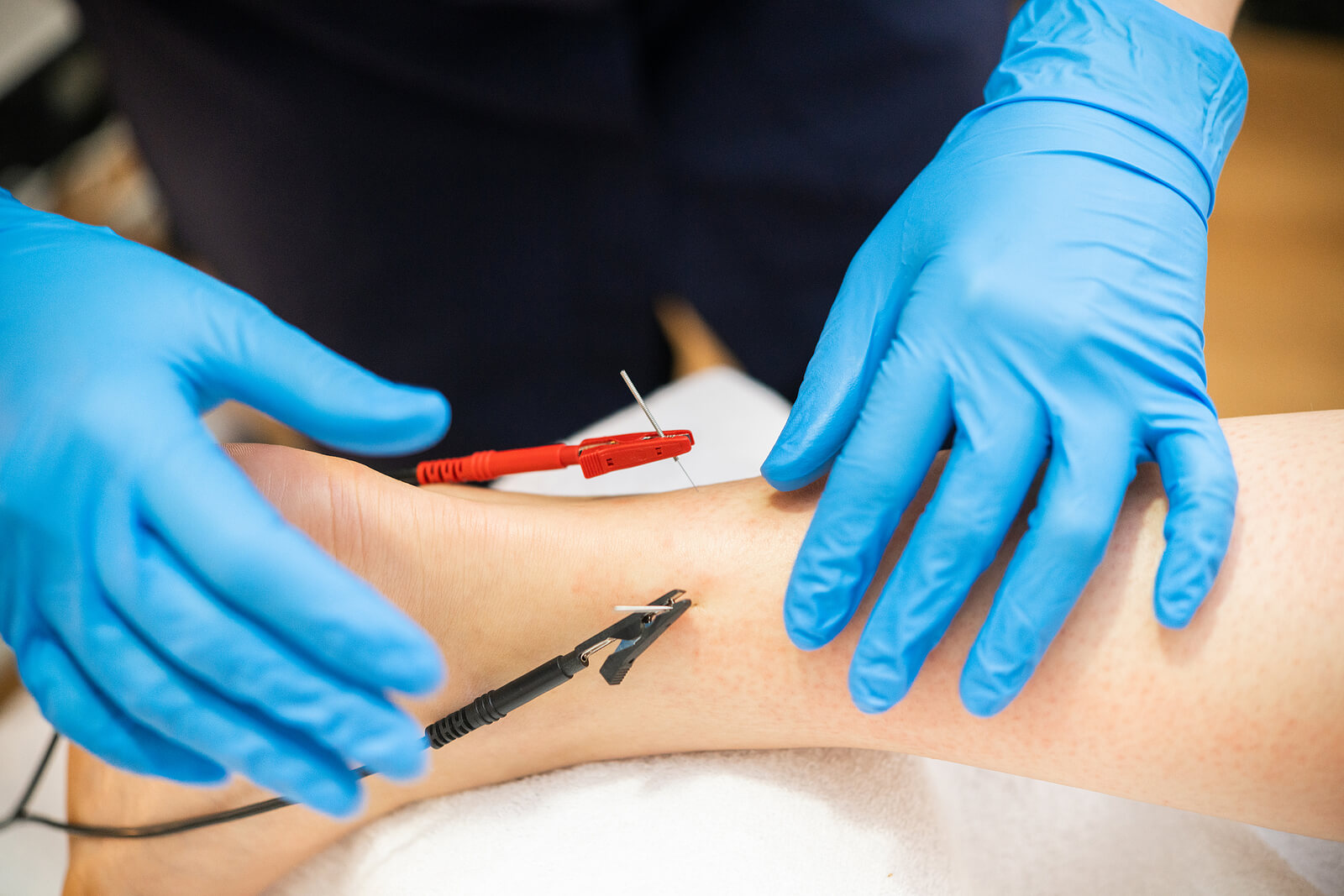 Electro Acupuncture Dry Needling